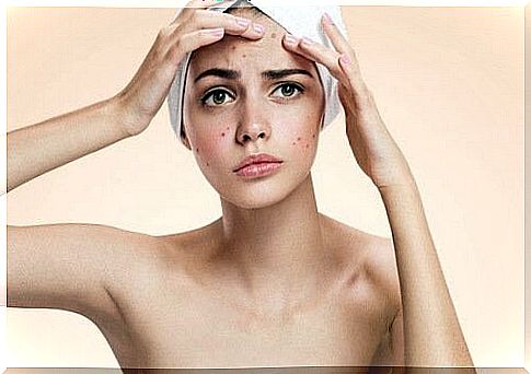 try acne beauty treatment for tomatoes