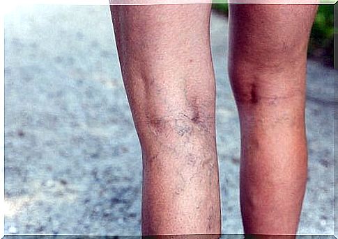 varicose veins