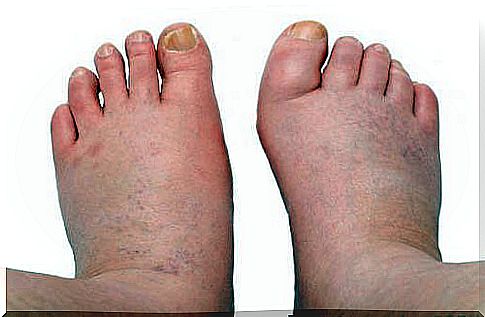 6 treatments for swollen feet