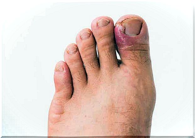 Nail fungal infections should be prevented because they are difficult to eradicate