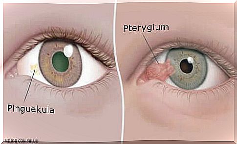 Tumors of the cornea: tension and pterygium