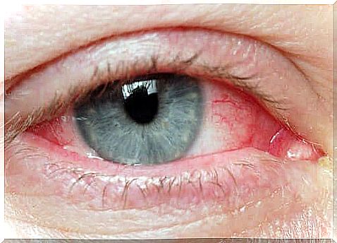 The most common symptoms of pinguecula are itchy eyes, redness of the eyeball and dry eyes.