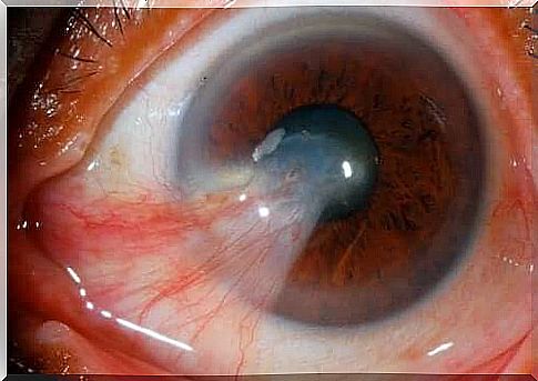 Pinguekula and pterygium are not located in the same place in the eye