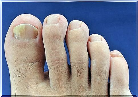 toe sandals can expose to nail fungus