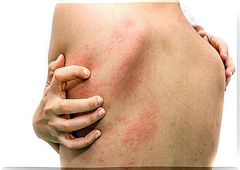 Home remedies for hives