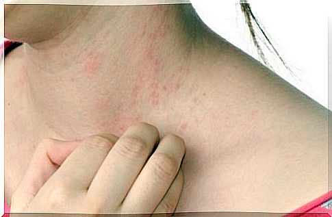 home remedies for hives