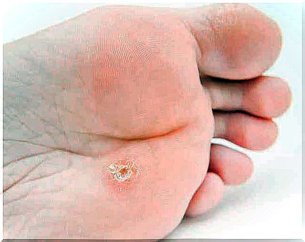 Foot warts often disappear on their own over time.