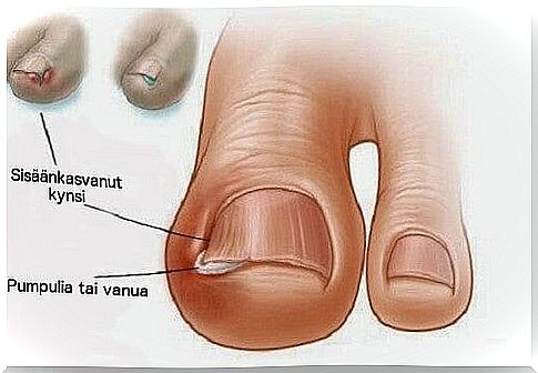 The most common toe ailments: ingrown toenail.