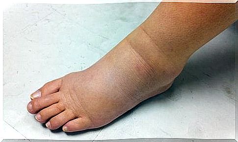 swelling in the ankle and leg