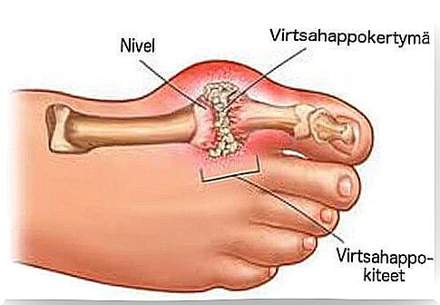 Uric acid in the leg