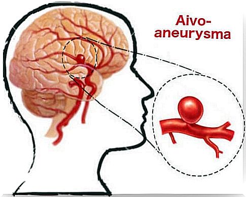 Prevent your aneurysm in a timely manner with these tips