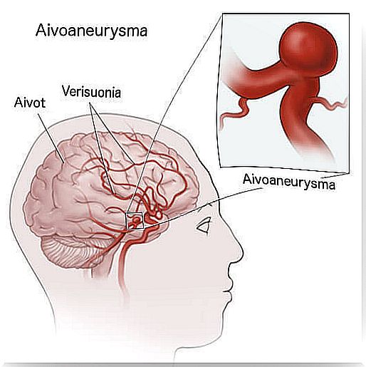 aneurysm in the brain