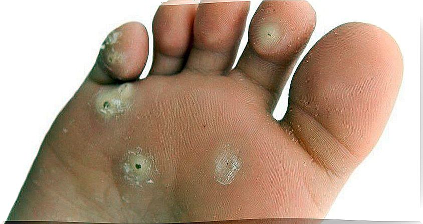 Remove small warts with one ingredient