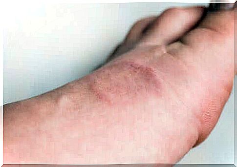 Symptoms and treatment of ring granuloma