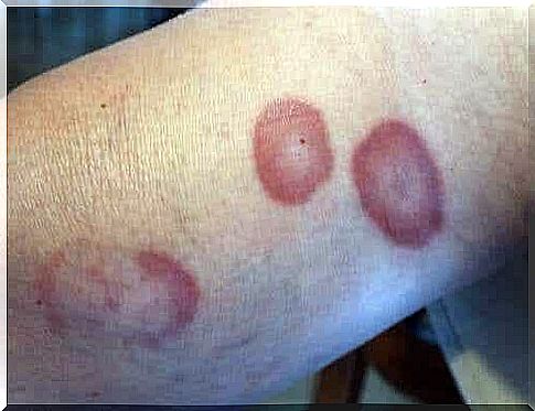 Symptoms of ring granuloma: red spots on the skin.