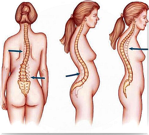 types of scoliosis