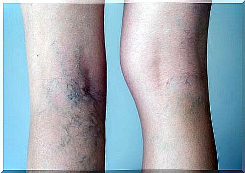 Varicose veins in a woman's legs