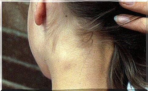 Swollen lymph nodes - is it serious?