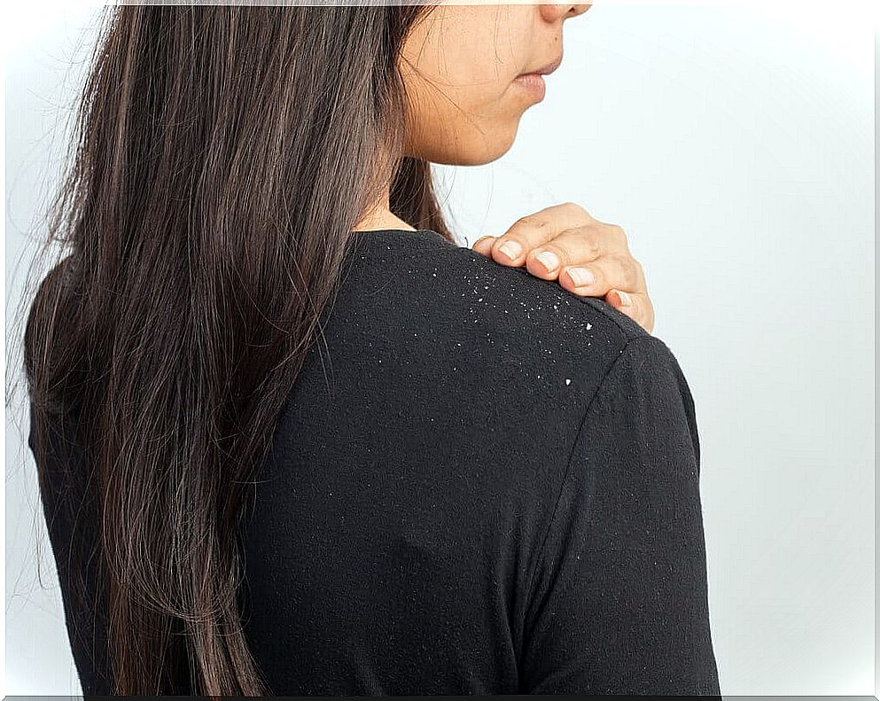 dandruff on the shoulder