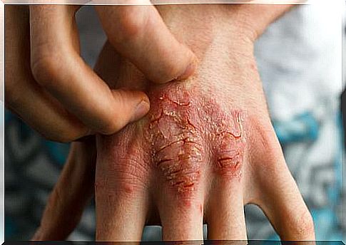 Psoriatic arthritis in the hand