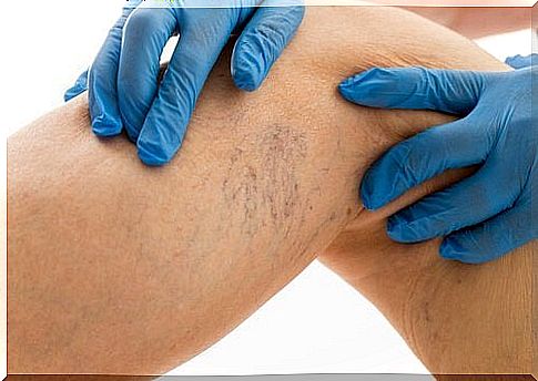 Treatment of varicose veins with 8 tips