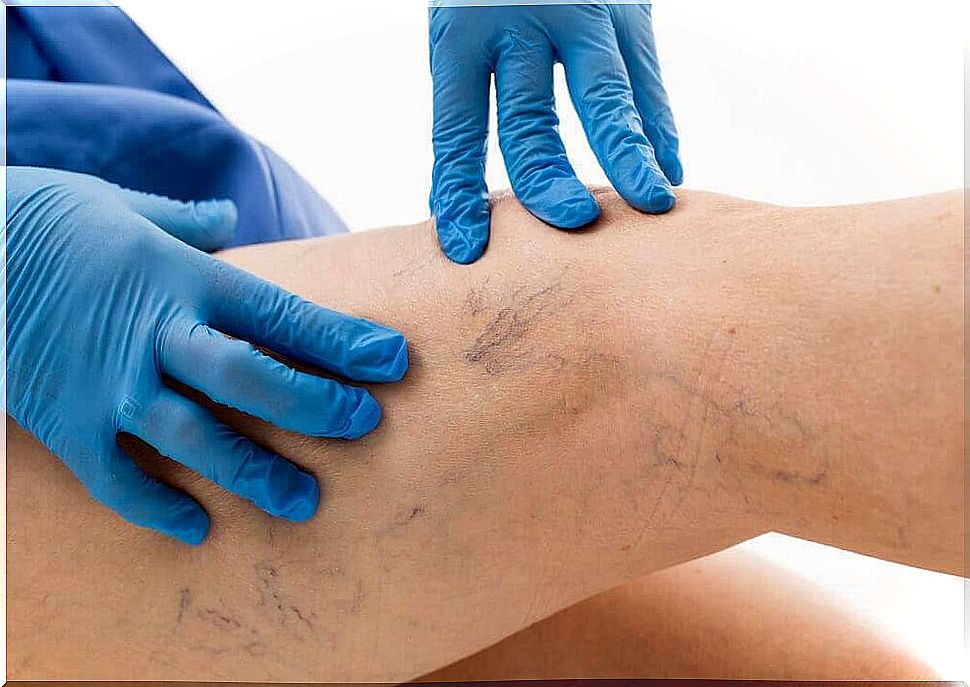 Varicose veins are dilated veins