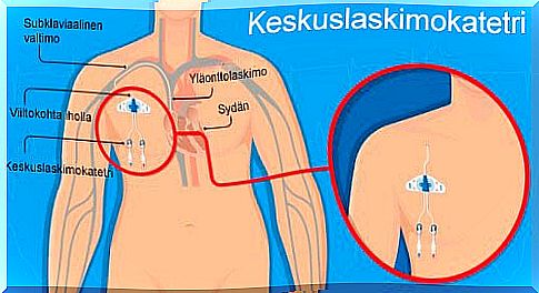 Vascular perforation and central venous catheters