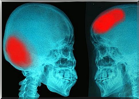 Stroke signs on x-ray